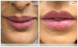 'Kiss Me' Lip Augmentation 01 - 2