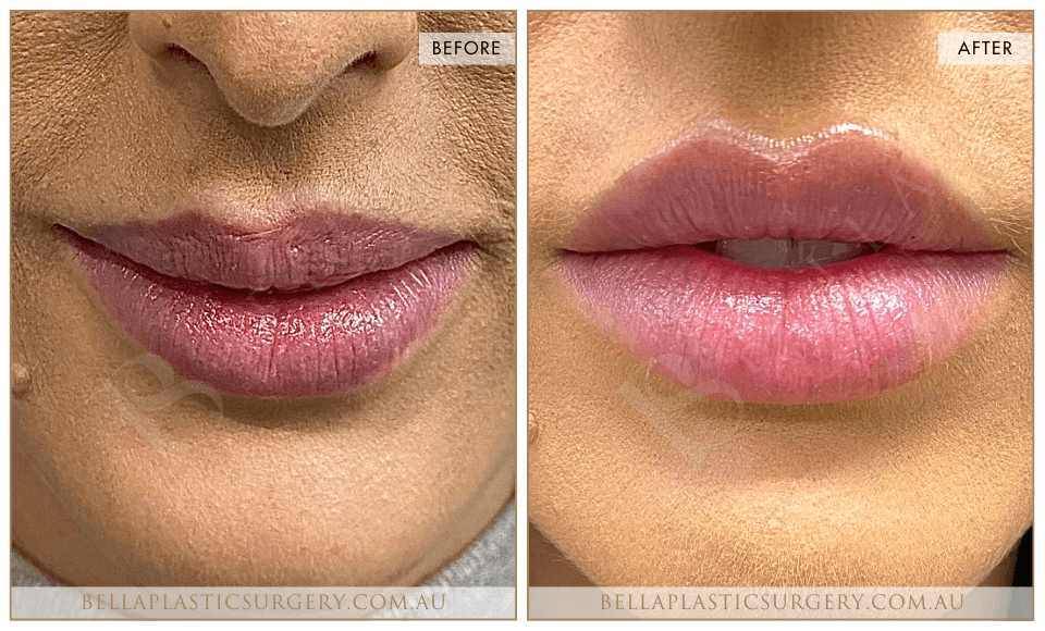 Non-Surgical BA Images, Bella Plastic Surgery