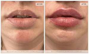 'Kiss Me' Lip Augmentation 05 - 3