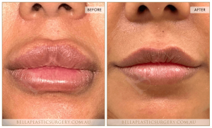 ‘Kiss Me’ Lip Augmentation 02 - 8