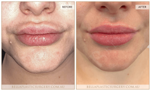 ‘Kiss Me’ Lip Augmentation 03 - 9