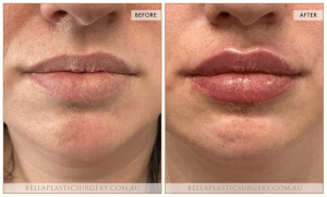 ‘Kiss Me’ Lip Augmentation 04 - 10
