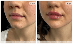 Lower Face Treatment 01 2 Lower Face Treatment 01 - 2