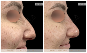 Non-Surgical Rhinoplasty 01 - 2