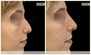 Non-Surgical Rhinoplasty 08 - 9