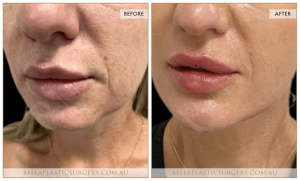 Lower Face Treatment 02 3 Lower Face Treatment 02 - 3
