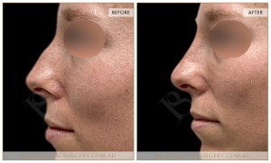 Non-Surgical Rhinoplasty 02 - 3