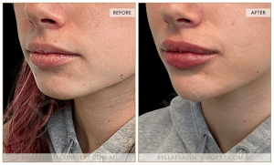 Lower Face Treatment 03 4 Lower Face Treatment 03 - 4