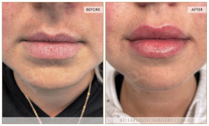 'Kiss Me' Lip Augmentation 06 - 4