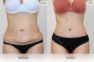 360 Tummy Tuck Patient 01 - 2