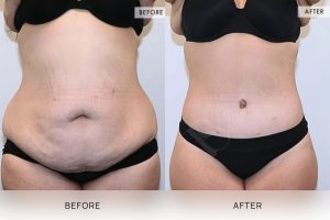360 Tummy Tuck Patient 10 - 11