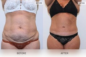 360 Tummy Tuck Patient 11 - 12