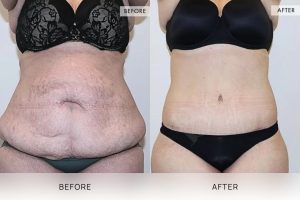 360 Tummy Tuck Patient 12 - 13