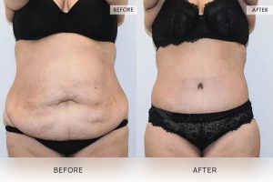 360 Tummy Tuck Patient 13 - 14