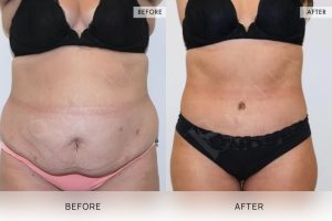 360 Tummy Tuck Patient 14 - 15