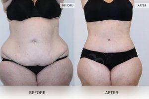 360 Tummy Tuck Patient 15 - 16