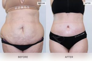 360 Tummy Tuck Patient 16 - 17