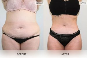 360 Tummy Tuck Patient 02 - 3