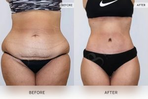 360 Tummy Tuck Patient 03 - 4