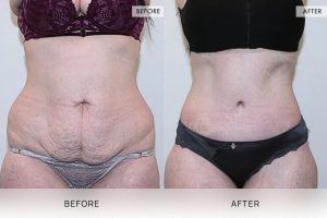 360 Tummy Tuck Patient 04 - 5