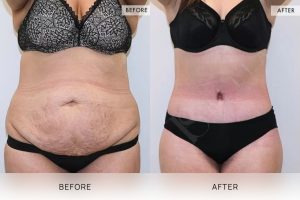 360 Tummy Tuck Patient 05 - 6