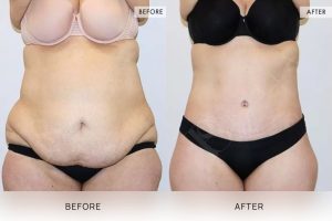 360 Tummy Tuck Patient 06 - 7