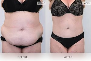 360 Tummy Tuck Patient 07 - 8