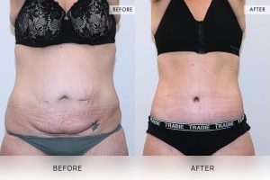 360 Tummy Tuck Patient 08 - 9