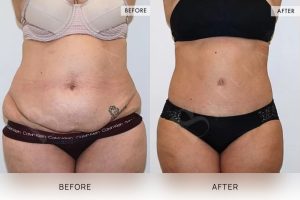 360 Tummy Tuck Patient 09 - 10