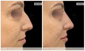 Non-Surgical Rhinoplasty 03 - 4