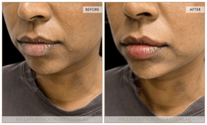 Lower Face Treatment 04 5 Lower Face Treatment 04 - 5