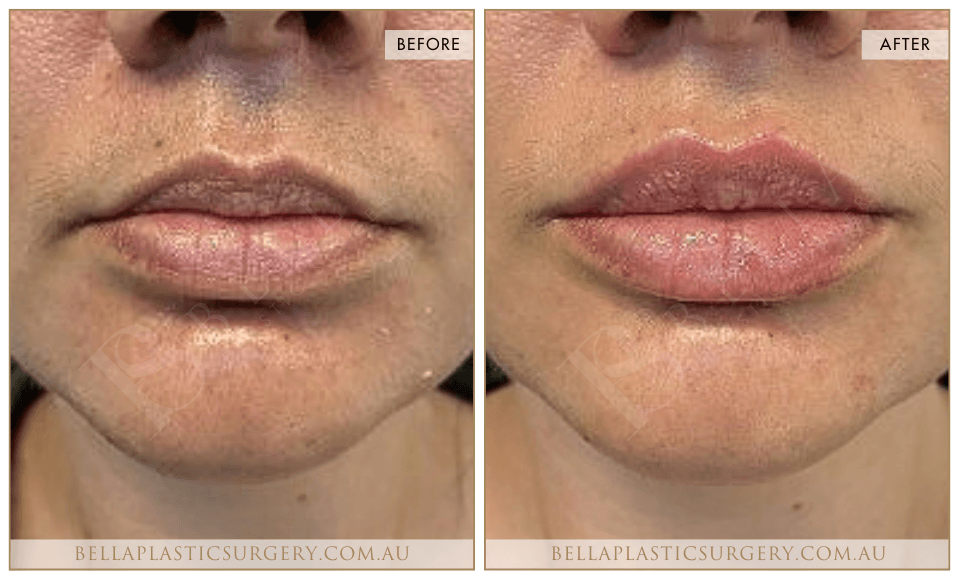 Non-Surgical BA Images, Bella Plastic Surgery