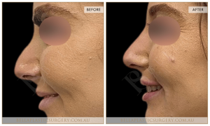 Non-Surgical Rhinoplasty 04 - 5