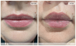 'Kiss Me' Lip Augmentation 08 - 6