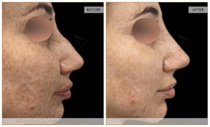 Non-Surgical Rhinoplasty 05 - 6