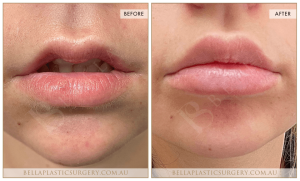 'Kiss Me' Lip Augmentation 09 - 7