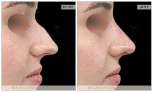 Non-Surgical Rhinoplasty 06 - 7