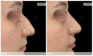 Non-Surgical Rhinoplasty 07 - 8