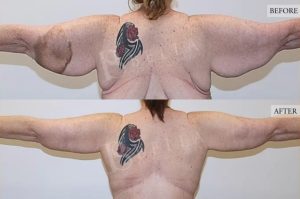 Arm Lift (Brachioplasty) Patient 01 - 2
