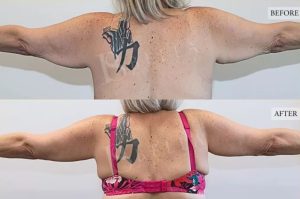 Arm Lift (Brachioplasty) Patient 10 - 11
