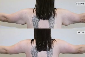 Arm Lift (Brachioplasty) Patient 11 - 12