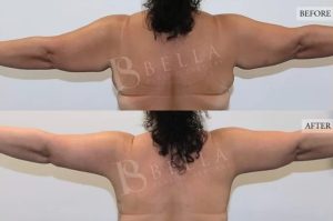 Arm Lift (Brachioplasty) Patient 12 - 13