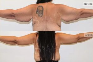 Arm Lift (Brachioplasty) Patient 02 - 3