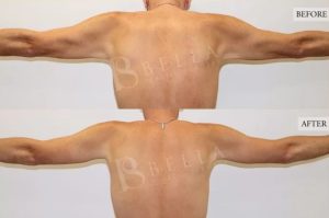 Arm Lift (Brachioplasty) Patient 03 - 4