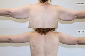Arm Lift (Brachioplasty) Patient 04 - 5