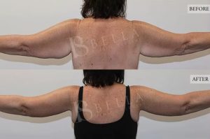 Arm Lift (Brachioplasty) Patient 05 - 6