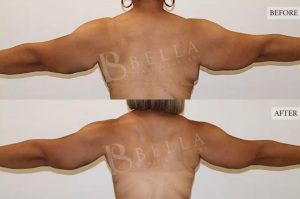 Arm Lift (Brachioplasty) Patient 06 - 7