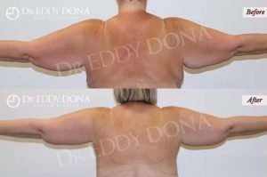 Arm Lift (Brachioplasty) Patient 07 - 8