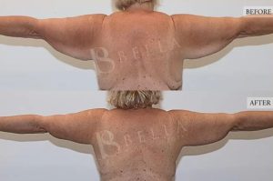 Arm Lift (Brachioplasty) Patient 08 - 9
