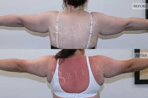 Arm Lift (Brachioplasty) Patient 09 - 10